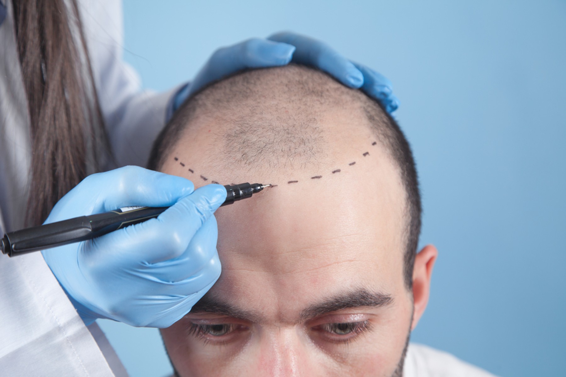 hair-transplant-service